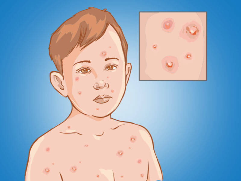 How To Flatten Chickenpox Scars? – ZXCAIH