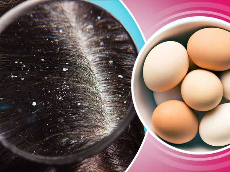 What Are The Best Hair Mask To Reduce Dandruff Easily lifealth