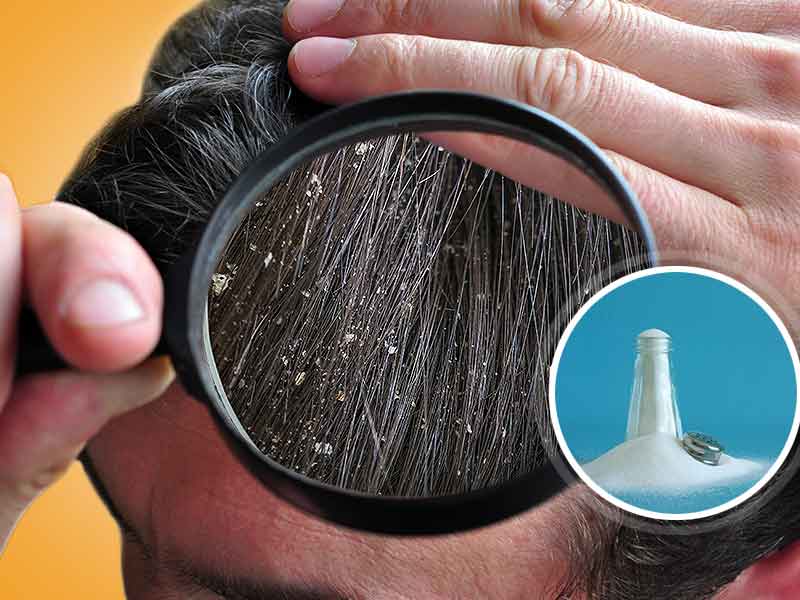 how to use salt for treating dandruff dc नमक का इस्तेमाल कैसे डैंड्रफ