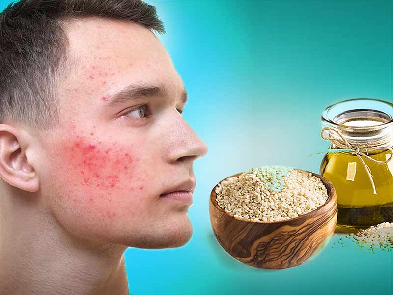 what are the ways to use sesame oil to reduce acne on face ish Sesame oil for acne तिल के तेल